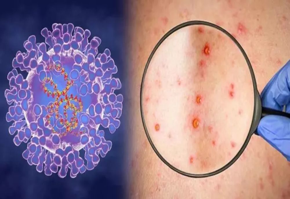 Alertă la Bruxelles - Zeci de mii de doze de vaccin pentru variola maimuței după cele peste 7.000 de cazuri în țări UE
