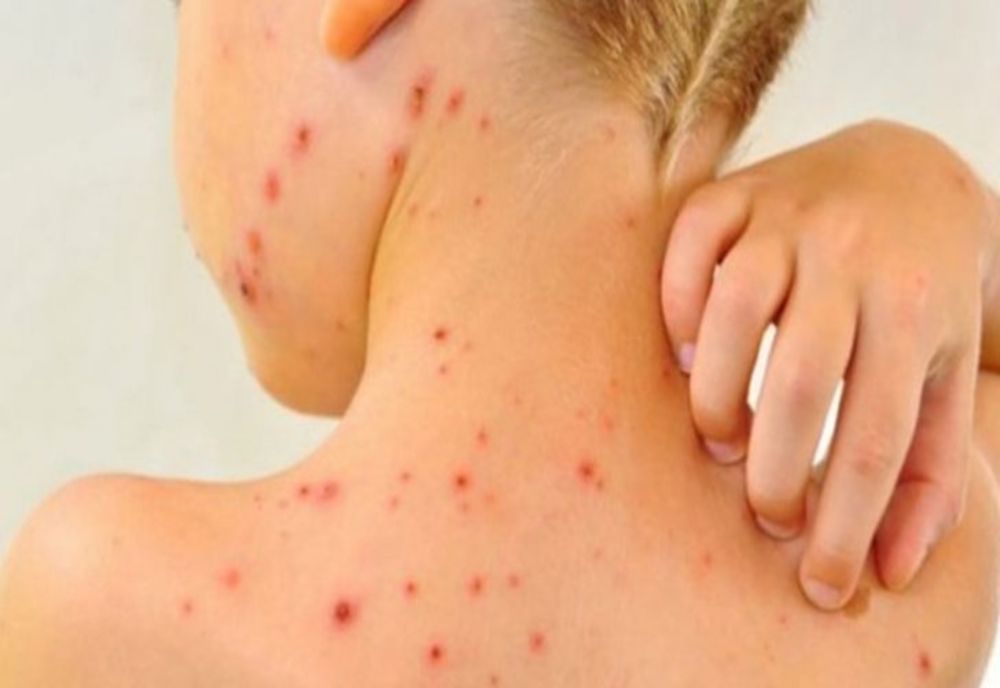 INSP: PESTE 1.000 DE CAZURI DE RUJEOLĂ ÎN ULTIMĂ LUNĂ DIN 2024